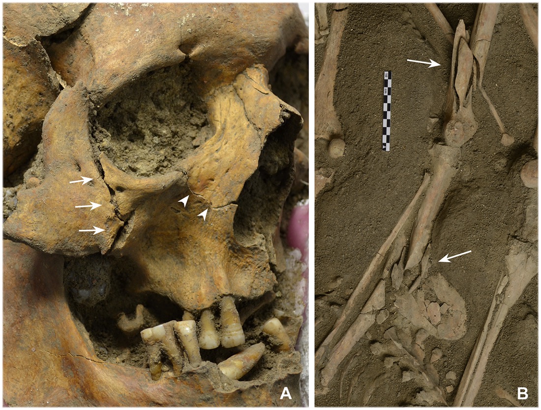 The oldest individual (between 40 and 50 years old) among the dead in the mass grave had fractures to the right cheekbone and the jawbone (A). The fracture to the right femur of another individual was likely associated with a fall, while a gunshot caused