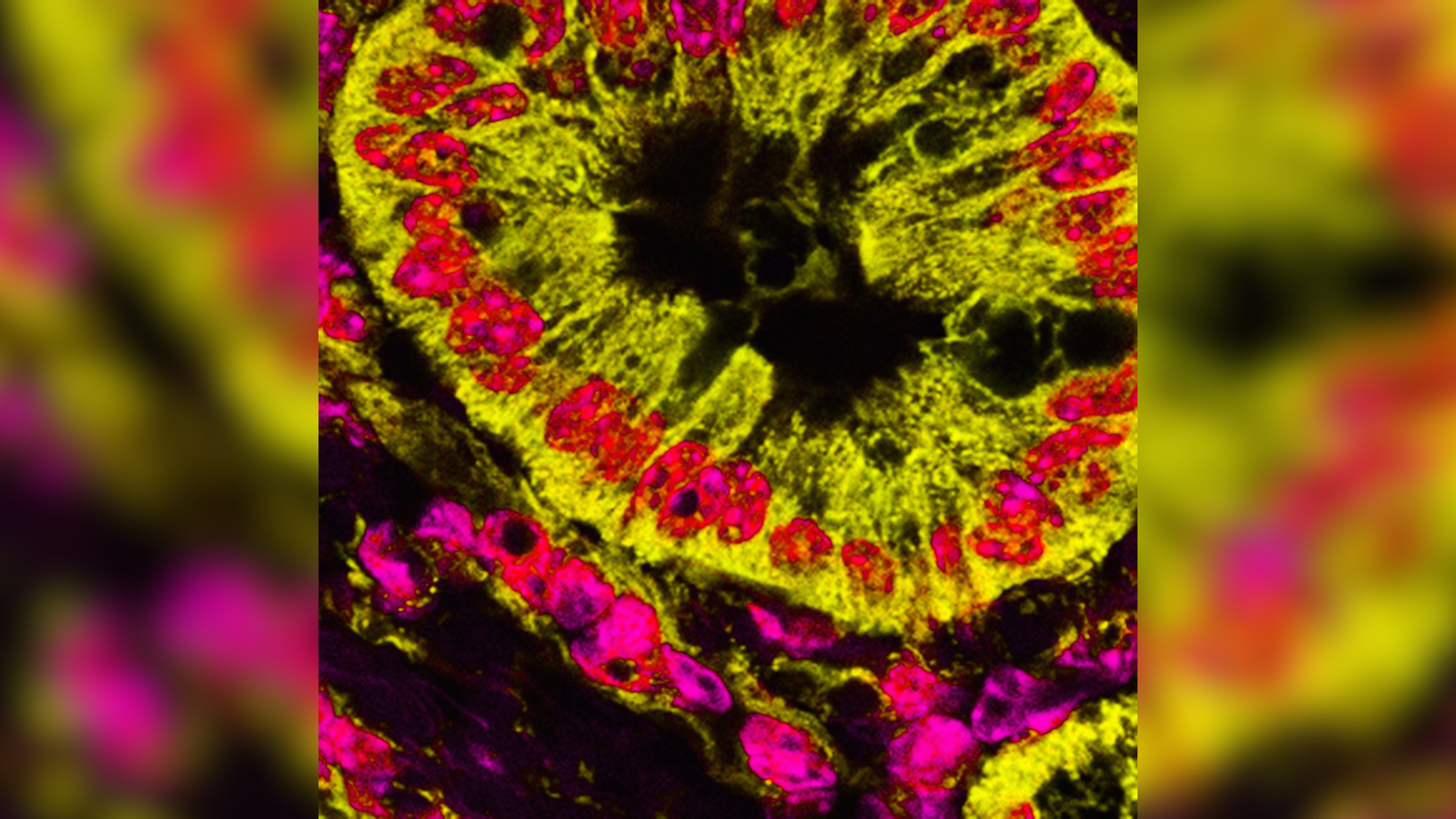 Multi-colored stained microscope image of cancerous cells in the pancreas. The cells are a yellow-green color and their mitochondria are pink. The background is black